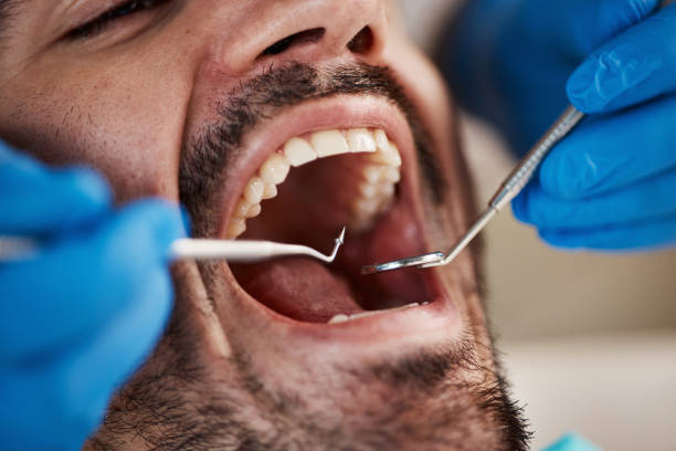 Best Emergency Tooth Extraction in Kyle, SD